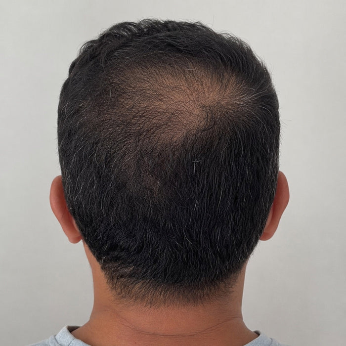 ANTES